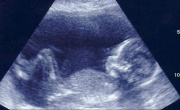 كيفية تحديد نوع الجنين بعد الحمل