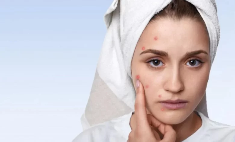 علاج ظهور الحبوب في الوجه بشكل مفاجئ