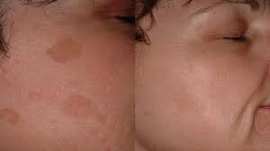 علاج التصبغات البنية في الوجه