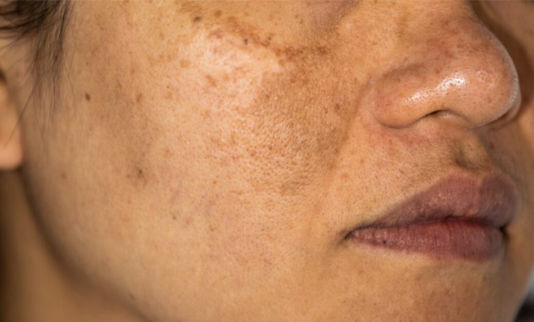 علاج التصبغات البنية في الوجه