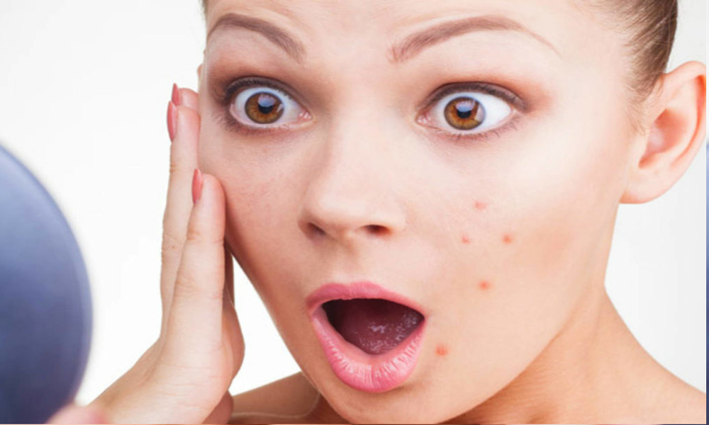 علاج ظهور الحبوب في الوجه بشكل مفاجئ