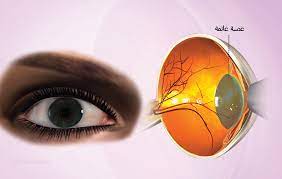 أعراض عصب العين
