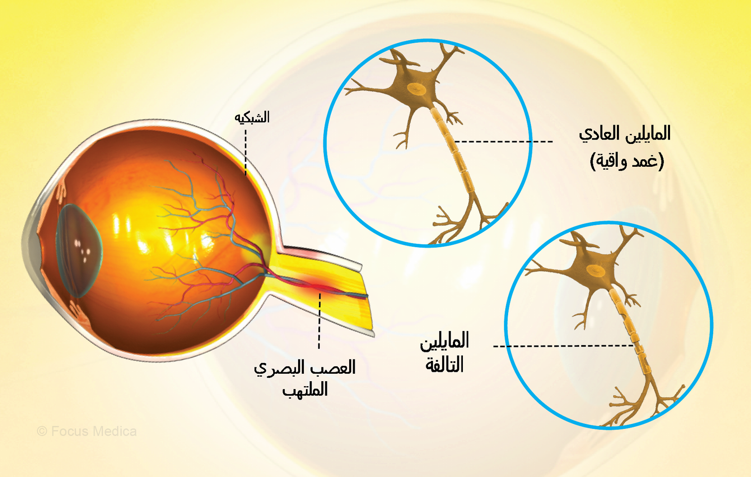 علاج التهاب العصب البصري